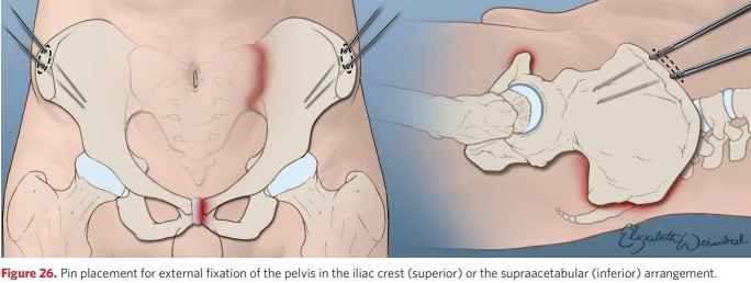 Placement of rods for external pelvic fixation