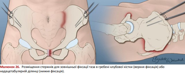 Розміщення стержнів для зовнішньої фіксації таза