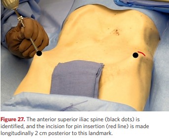 Placement of rods for external fixation of the pelvis in the iliac crest