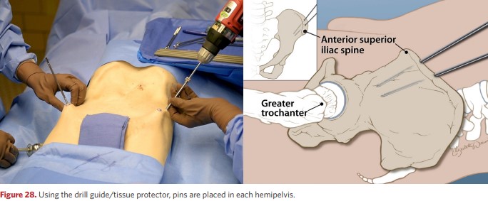 The rods are placed in each half of the pelvis