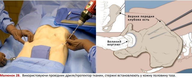 Стержні встановлюють у кожну половину таза