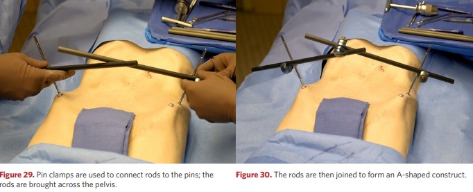 The rods are connected in the form of an A-frame