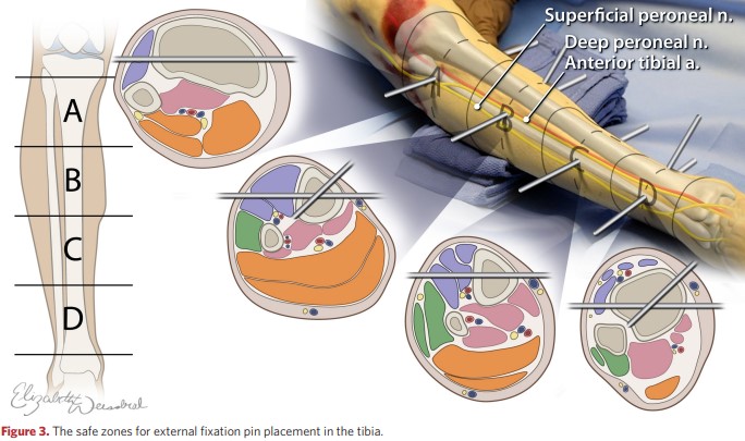 Safe areas for insertion of the external fixation rod into the tibia