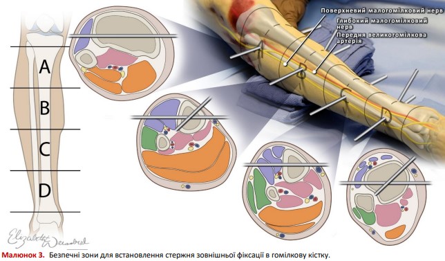 Безпечні зони для встановлення стержня зовнішньої фіксації в гомілкову кістку