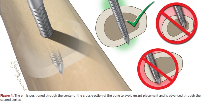 The rod is passed through the centre of the bone cross-section