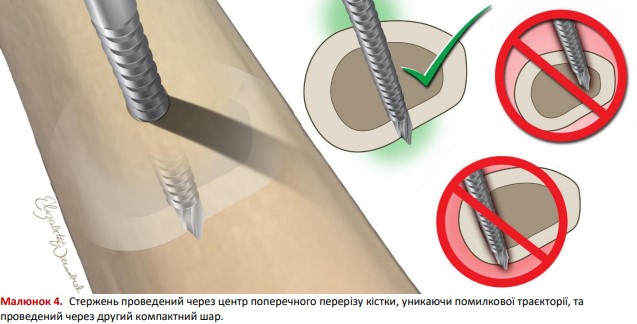Стержень проведений через центр поперечного перерізу кістки
