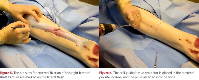 Insertion points for external fixation rods