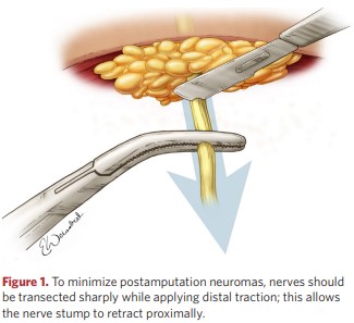 Nerve dissection and distal traction