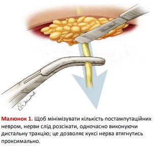 Розсічення нерва та дистальна тракція