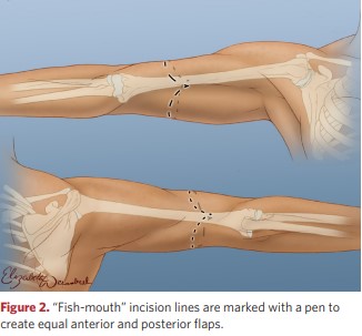 “Fish-mouth” incision lines