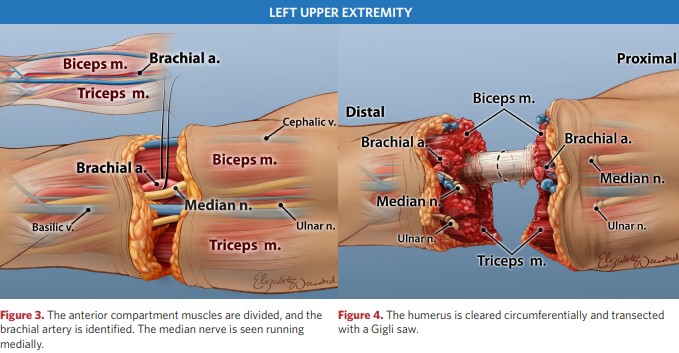 The humerus is dissected with a Gigli saw