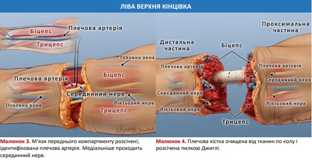 Плечова кістка розсічена пилкою Джиглі