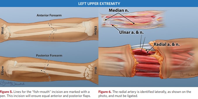 The radial artery