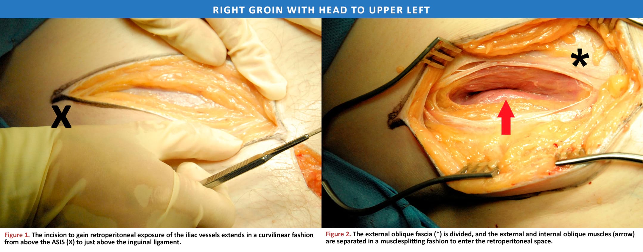 Incision for retroperitoneal access