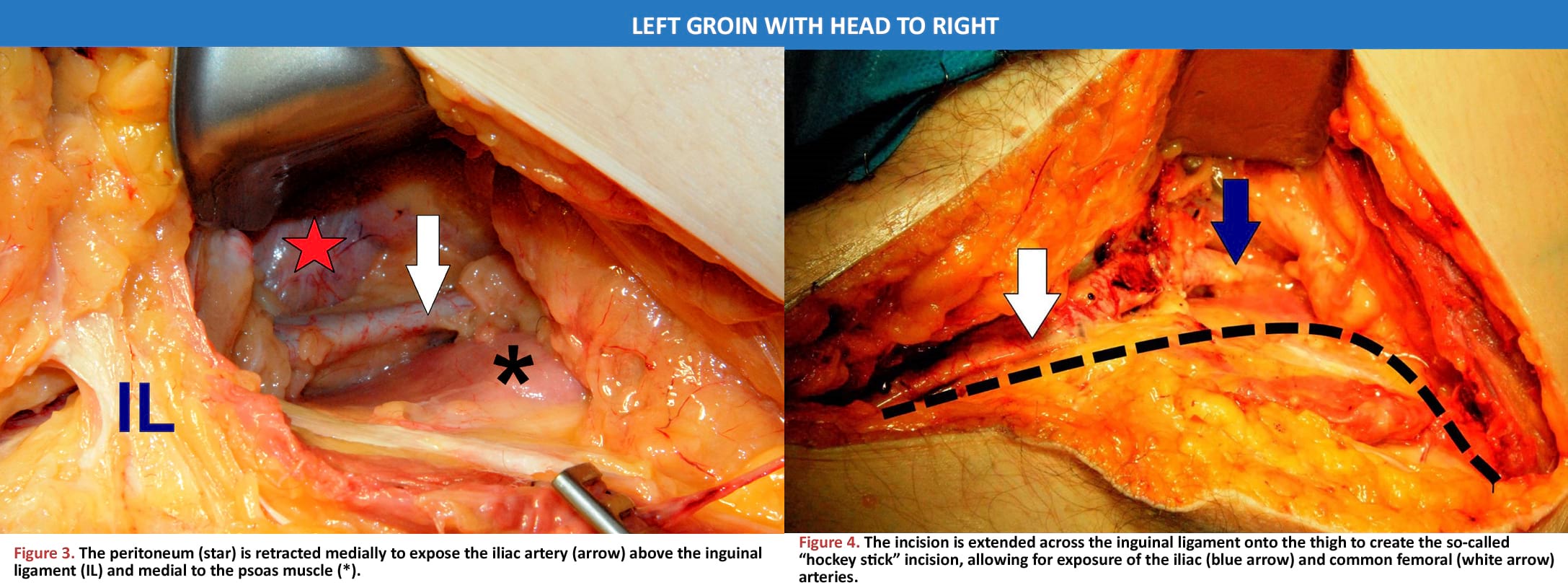 Access the iliac artery