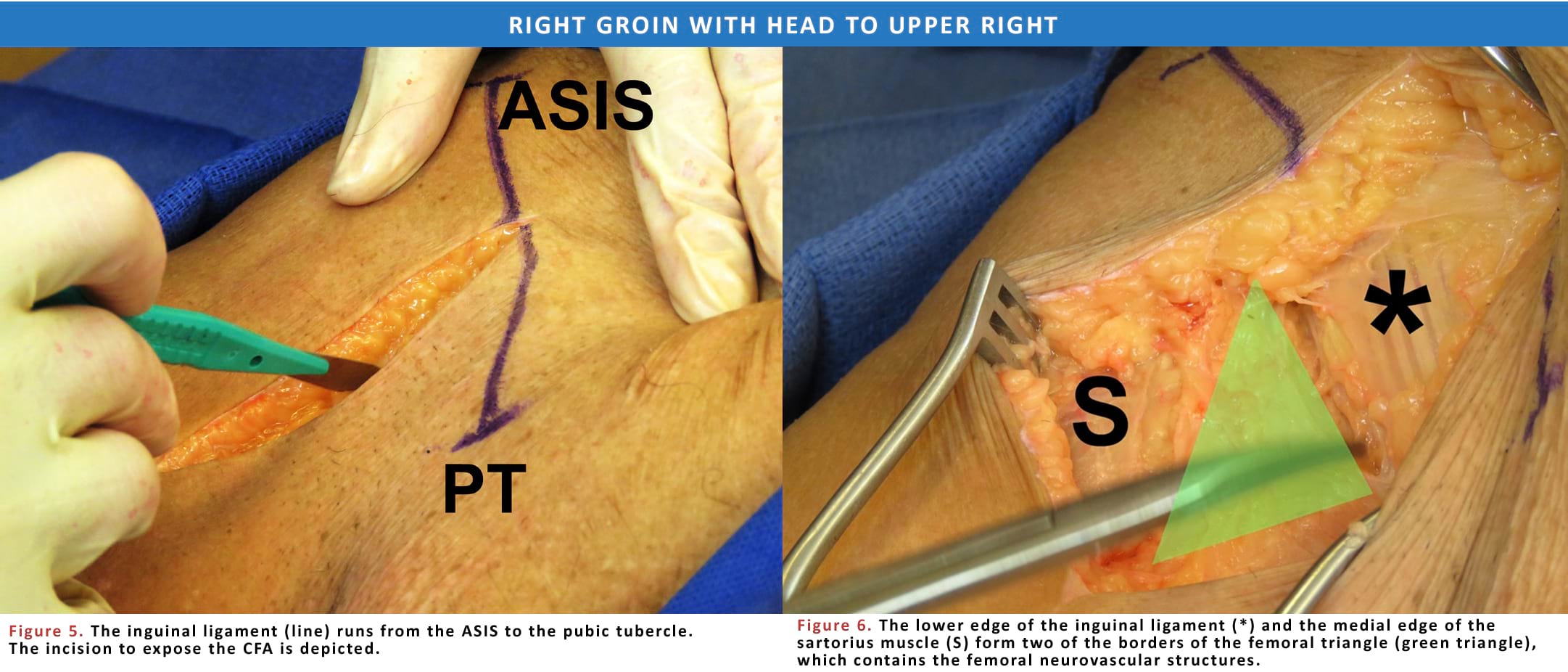 Incision for examination of the CF