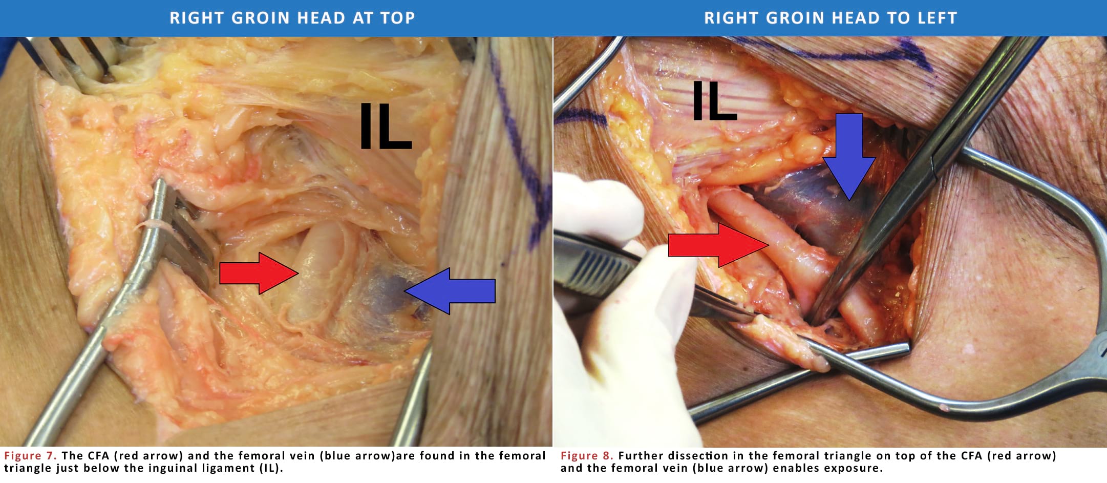 Using the lower edge of the inguinal ligament as a landmark, the femoral vessels are exposed in the femoral triangle