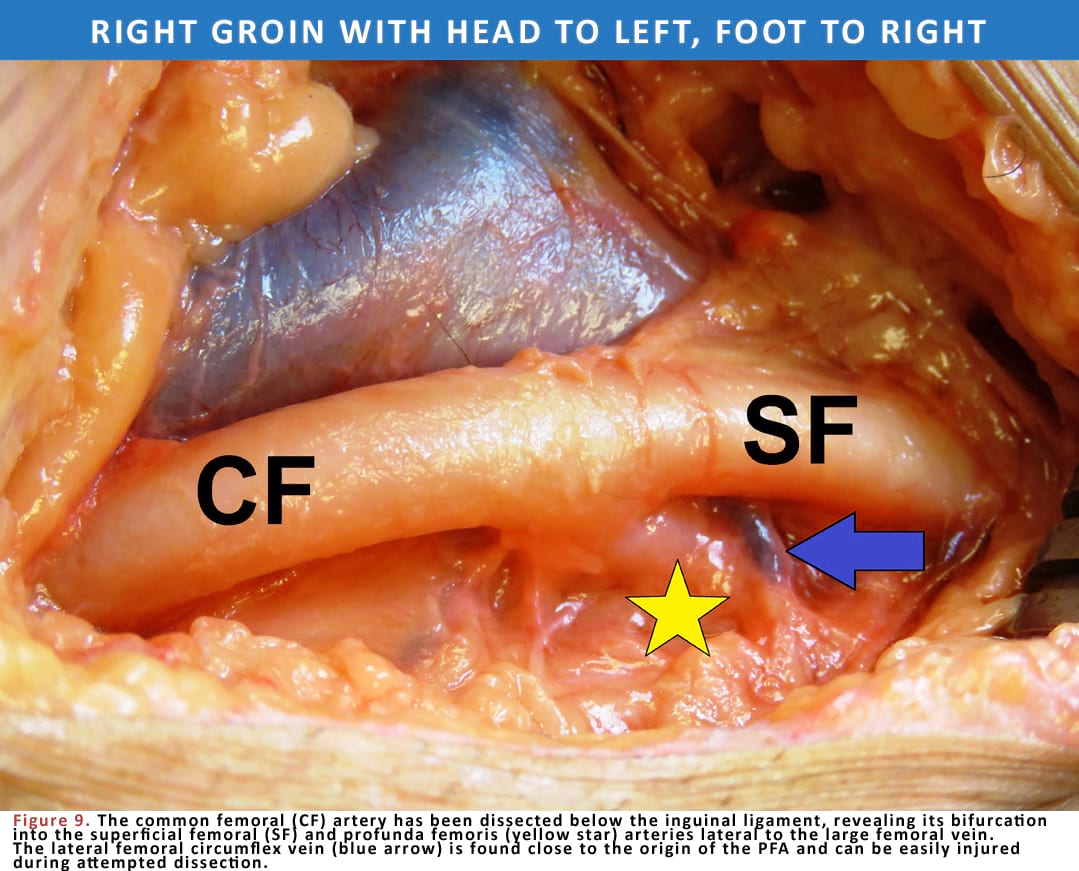 The profunda femoris (deep femoral) artery (PFA) is the largest branch of the CFA and is usually found 4–6 centimeters below the inguinal ligament. It follows a posterolateral course