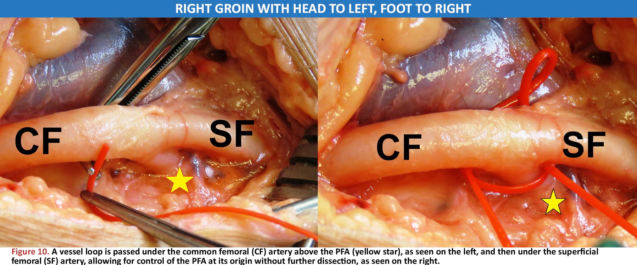 CFA, SFA, and PFA can all be controlled with vessel loops 