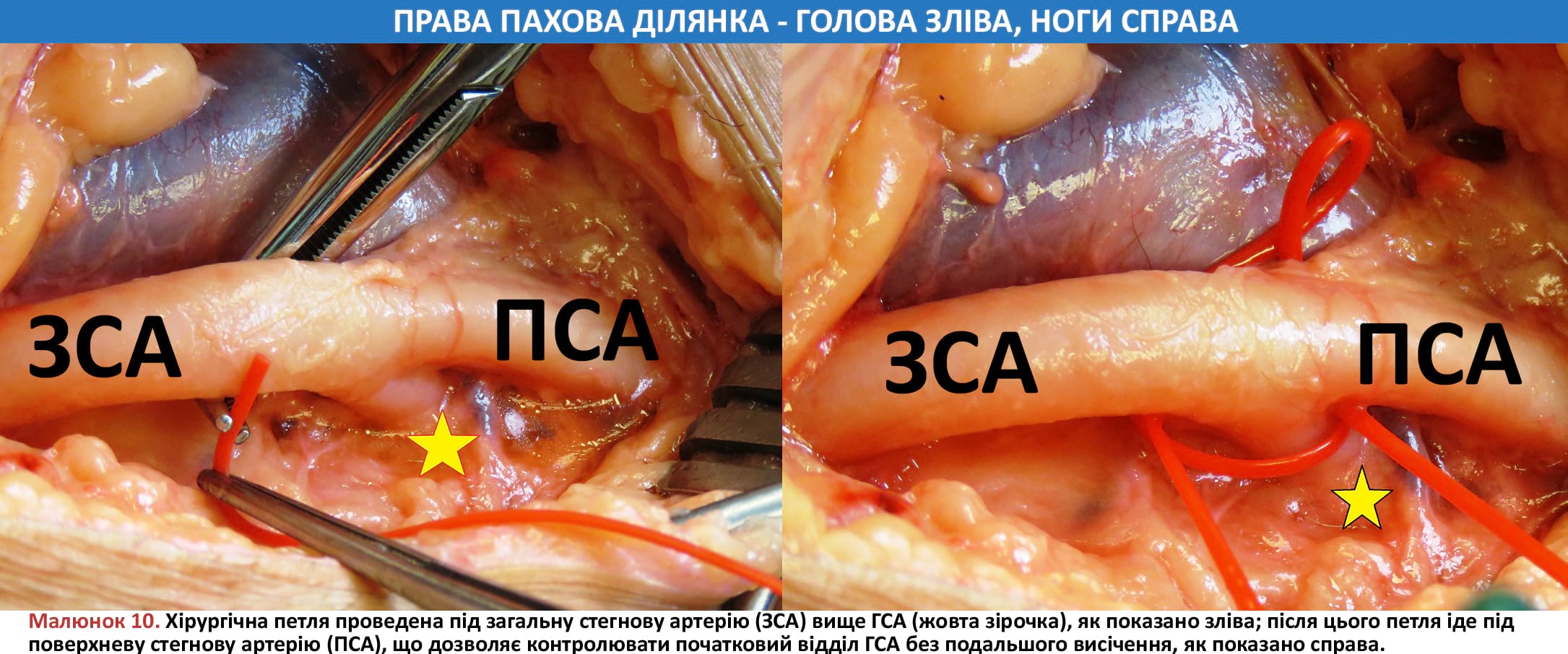 Контроль ЗСА, ПСА та ГСА за допомогою хірургічних петель