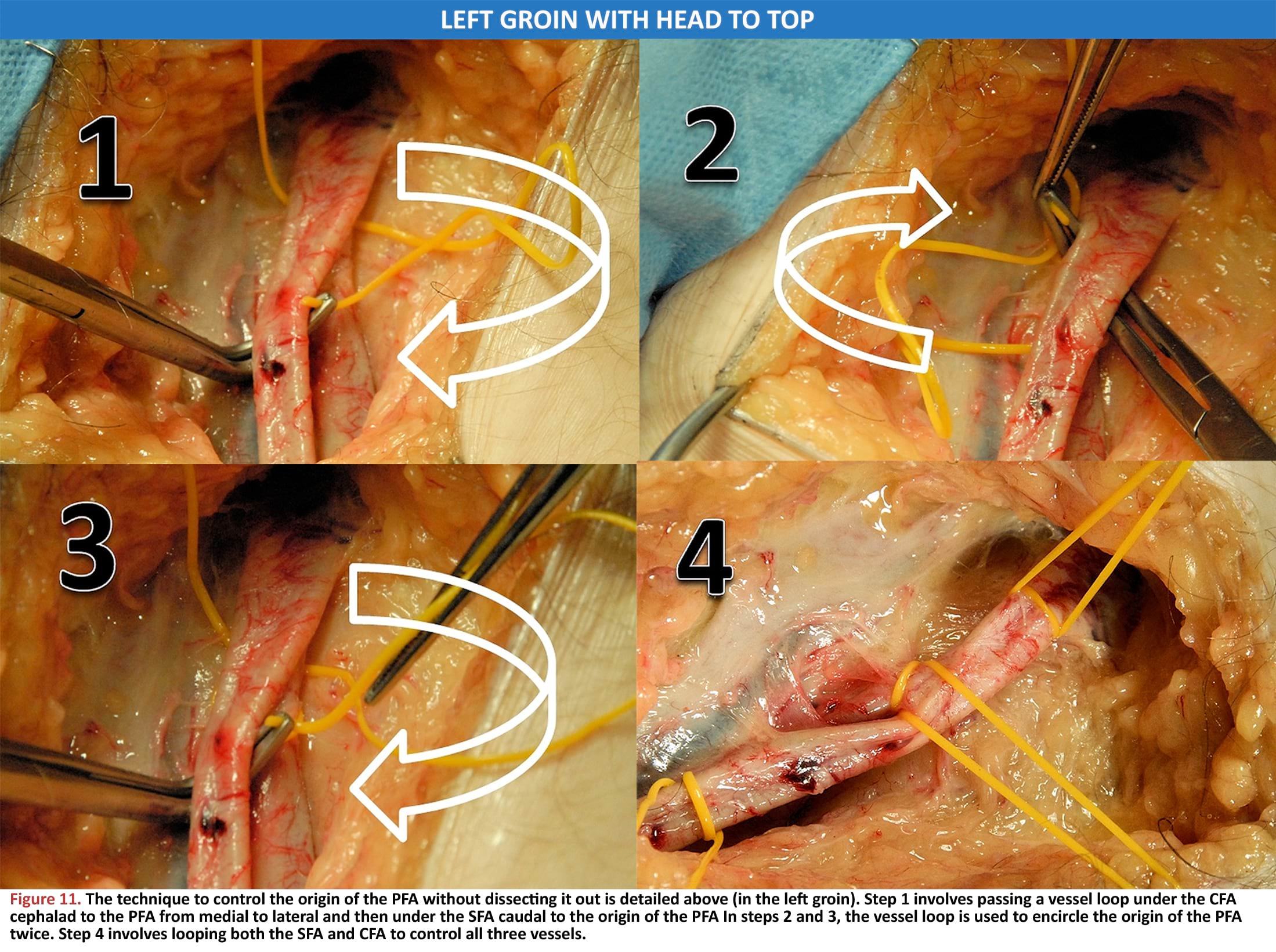 The technique to control the origin of the PFA without dissecting it out is detailed above