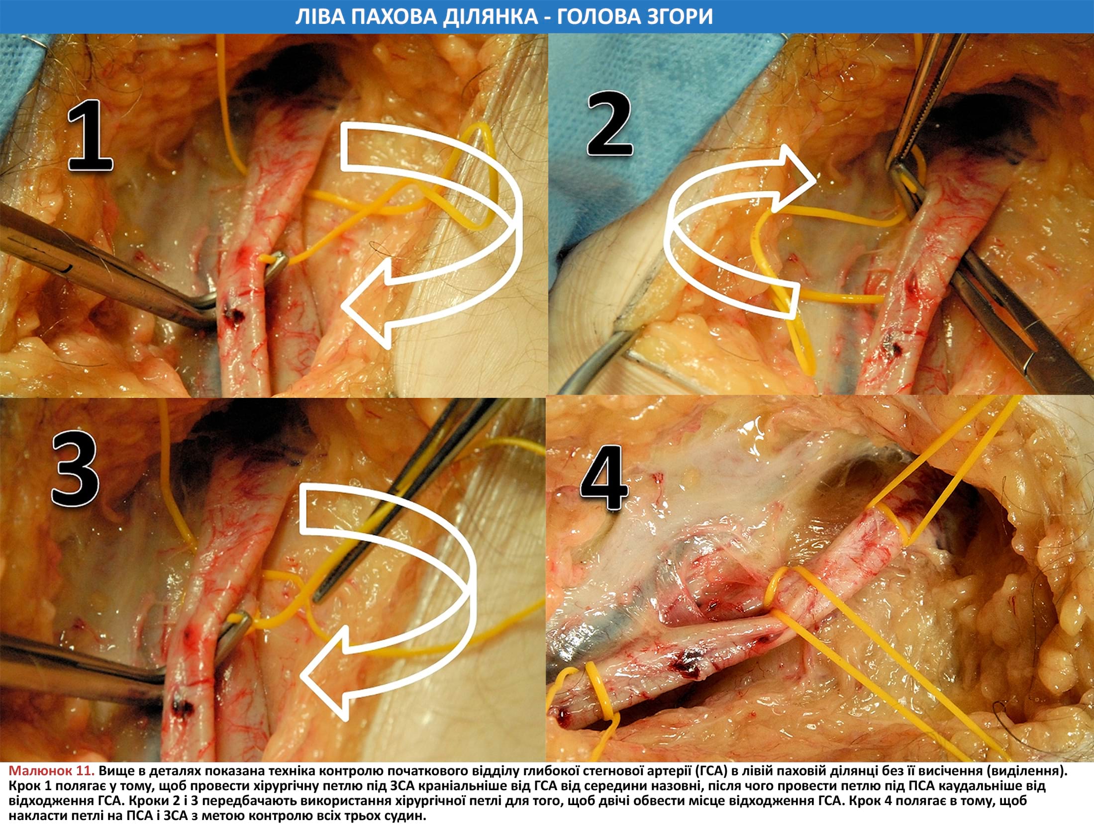  Техніка контролю початкового відділу глибокої стегнової артерії (ГСА) в лівій паховій ділянці без її висічення