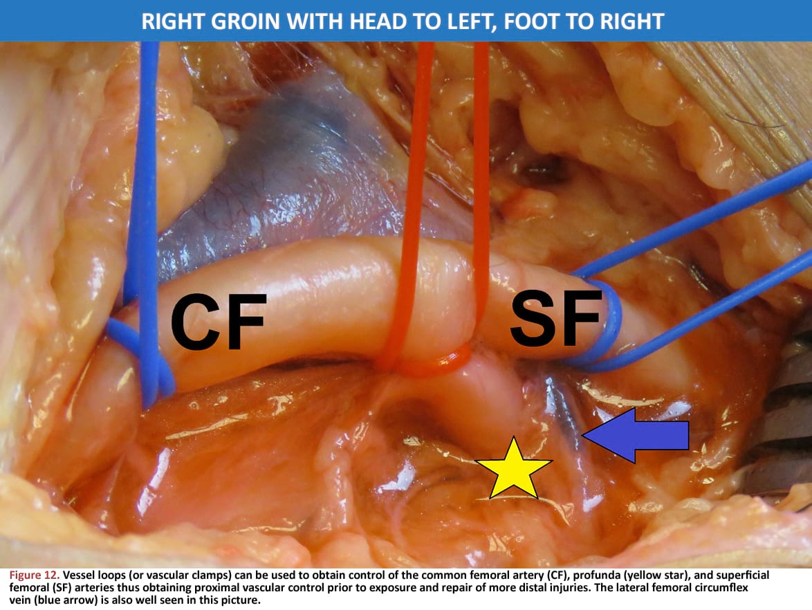 Vessel loops (or vascular clamps) can be used to obtain control of the common femoral artery