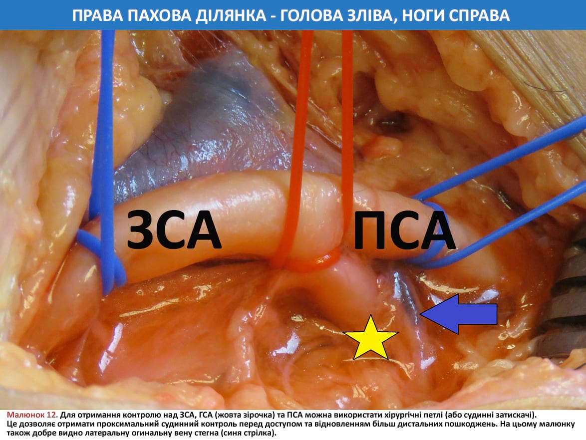 Для отримання контролю над ЗСА, ГСА та ПСА можна використати хірургічні петлі (або судинні затискачі)