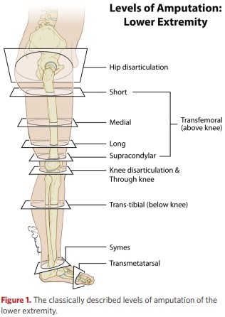 The classically described levels of amputation of the lower extremity