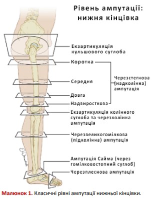 Класичні рівні ампутації нижньої кінцівки