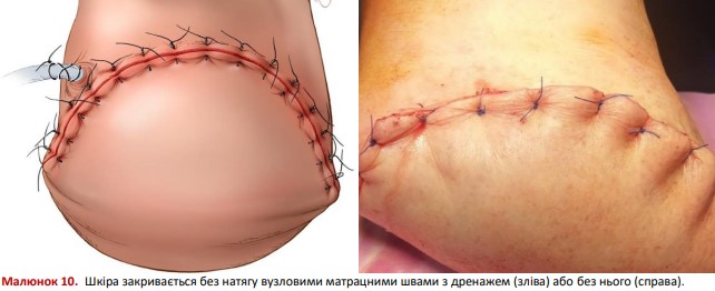 Шкіра закривається без натягу вузловими матрацними швами