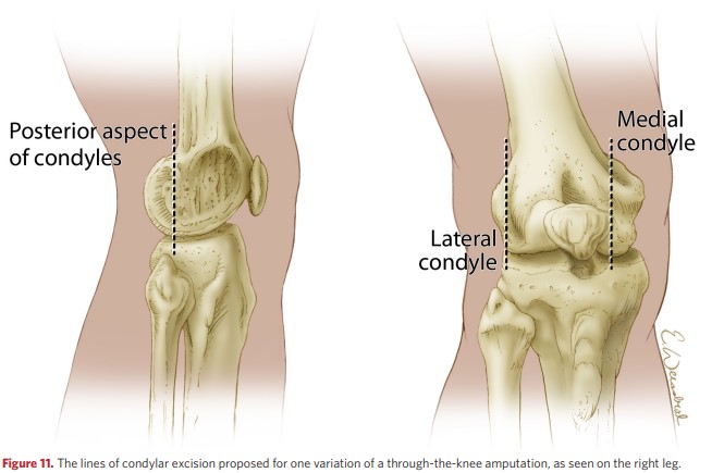 Lines for excision of condyles