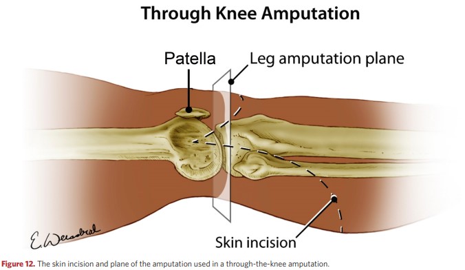 Skin incision and amputation plane in percutaneous amputation