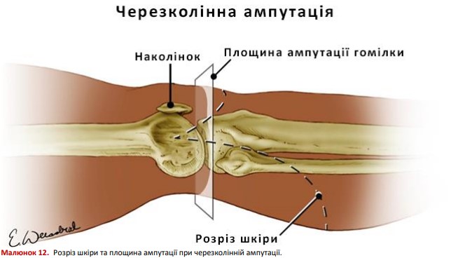 Розріз шкіри та площина ампутації при черезколінній ампутації