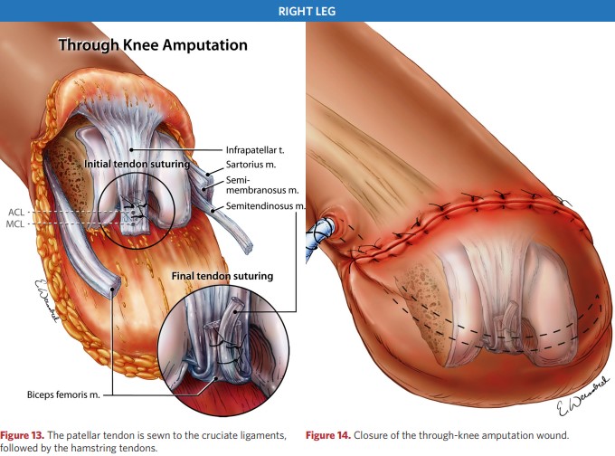 Amputation wound closure after TKA