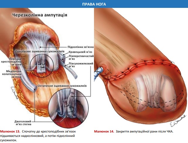 Закриття ампутаційної рани після ЧКА