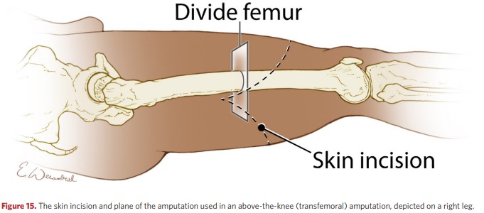 Skin incision and amputation plane in transfemoral amputation on the right leg