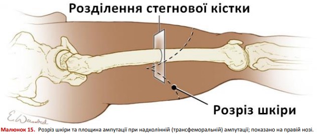 Розріз шкіри та площина ампутації при трансфеморальній ампутації на правій нозі