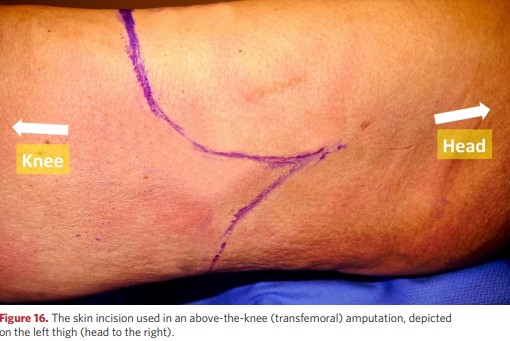 Skin incision for transfemoral amputation on the left thigh