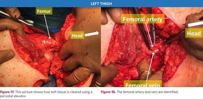 How to remove soft tissue with a dissector