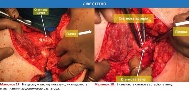 Як видаляють м’які тканини за допомогою распатора