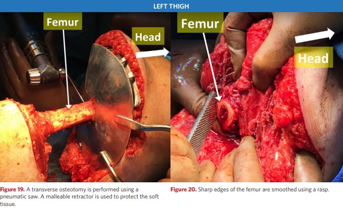 The sharp edges of the femur are smoothed out with a spreader