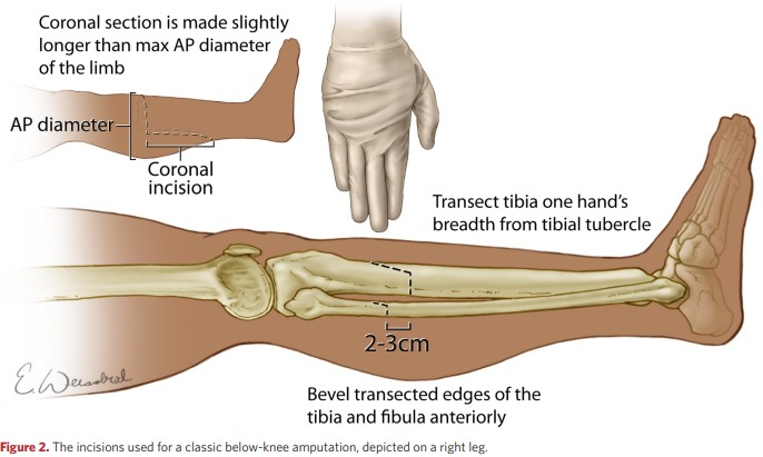 The incisions used for a classic below-knee amputation, depicted on a right leg