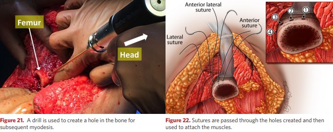 For further myodesis, a hole is created in the bone with a drill