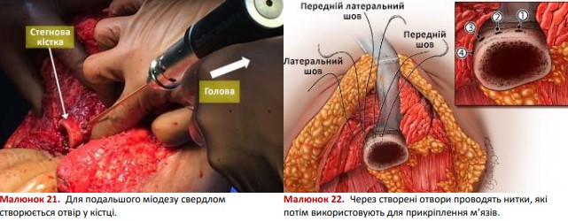 Для подальшого міодезу свердлом створюється отвір у кістці