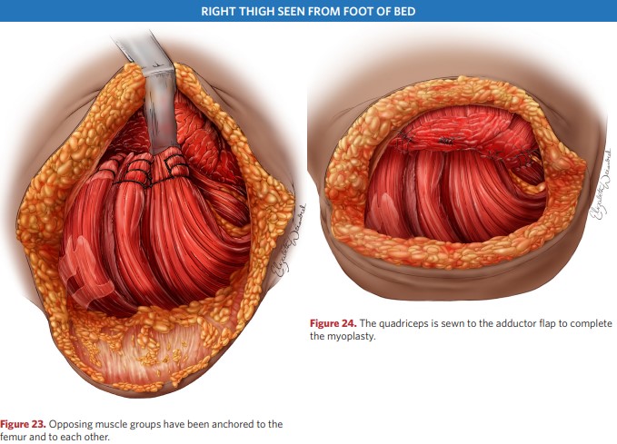 Hip myoplasty after amputation