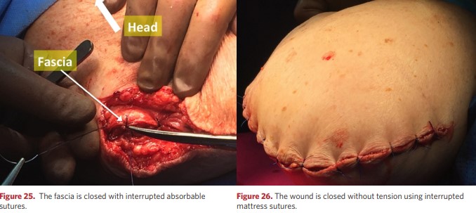 The fascia is closed with nodular absorbable sutures