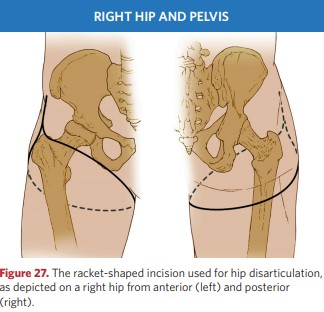 Racket-shaped incision