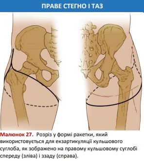 Розріз у формі ракетки