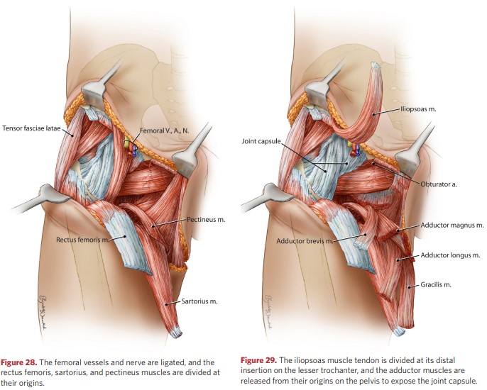 The tendon of the iliolumbar muscle is dissected